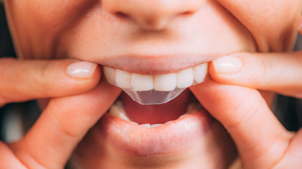 הלבנת שיניים ניפוץ מיתוסים