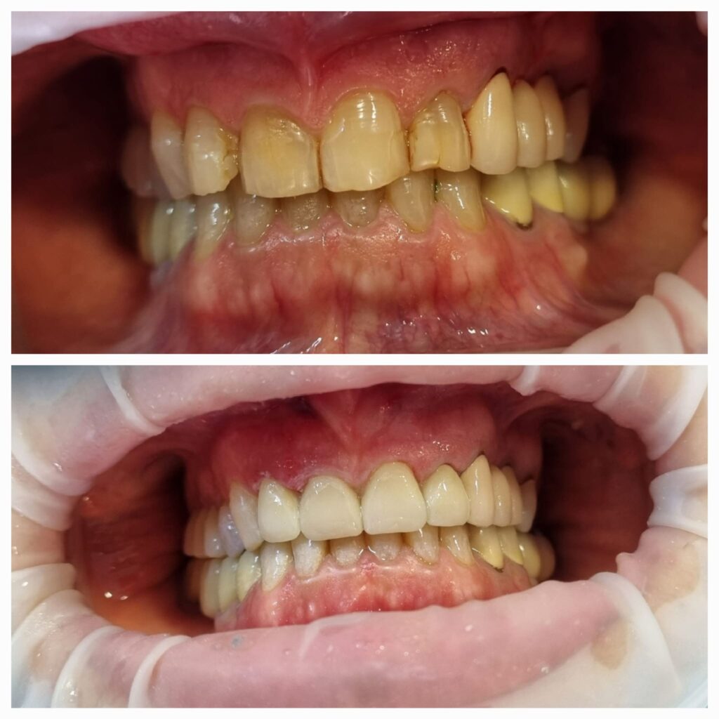 ציפוי שיניים זירקוניה 4 קדמיות עליונות