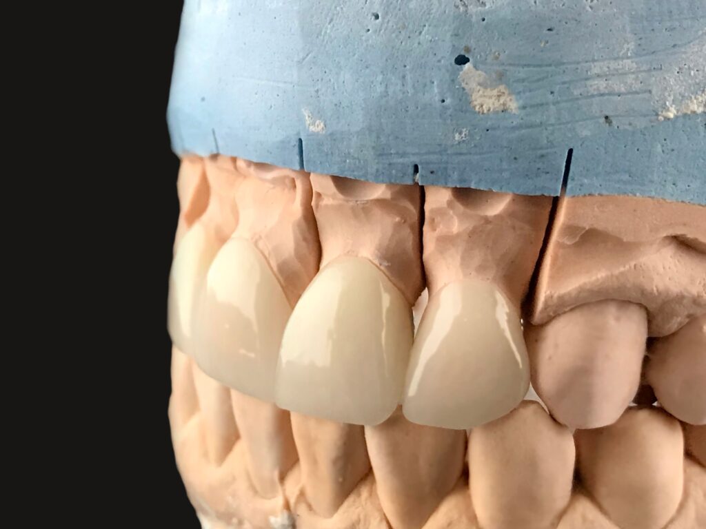 שאלות נפוצות על ציפוי שיניים זירקוניה