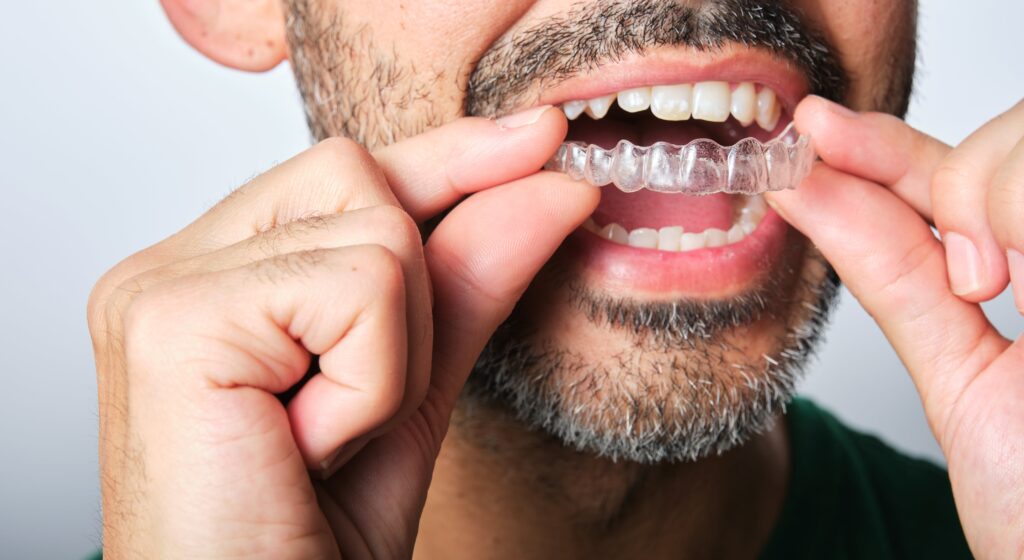 יישור שיניים שקוף היתרונות הברורים