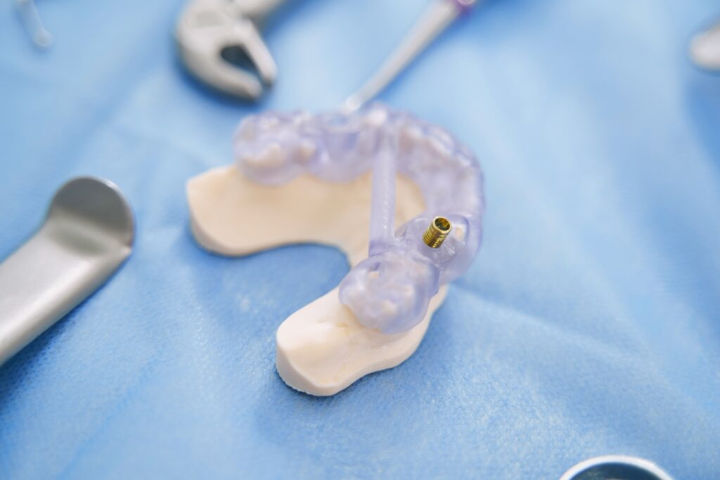 התהליך של השתלת שיניים בלסת תחתונה