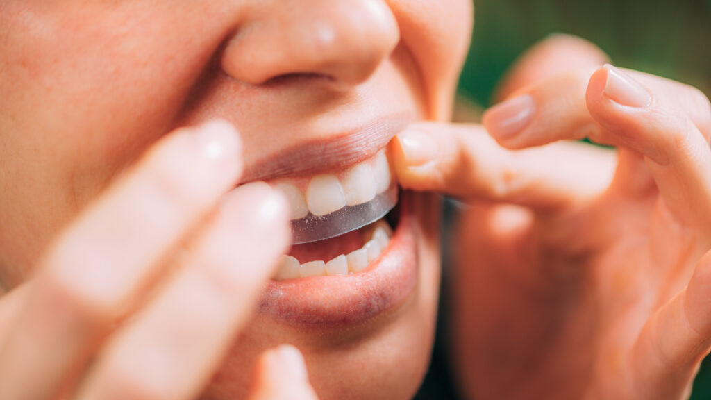 היתרונות של הלבנת שיניים ביתית